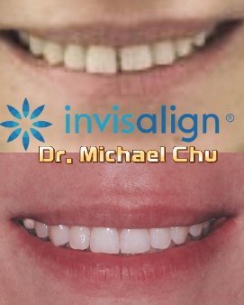 隐适美关闭牙缝 – Dr Michael Chu